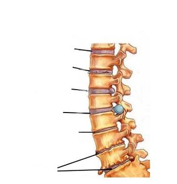 Etapas de desenvolvemento da osteocondrose