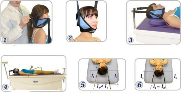 Tratamento da osteocondrose cervical con eliminación