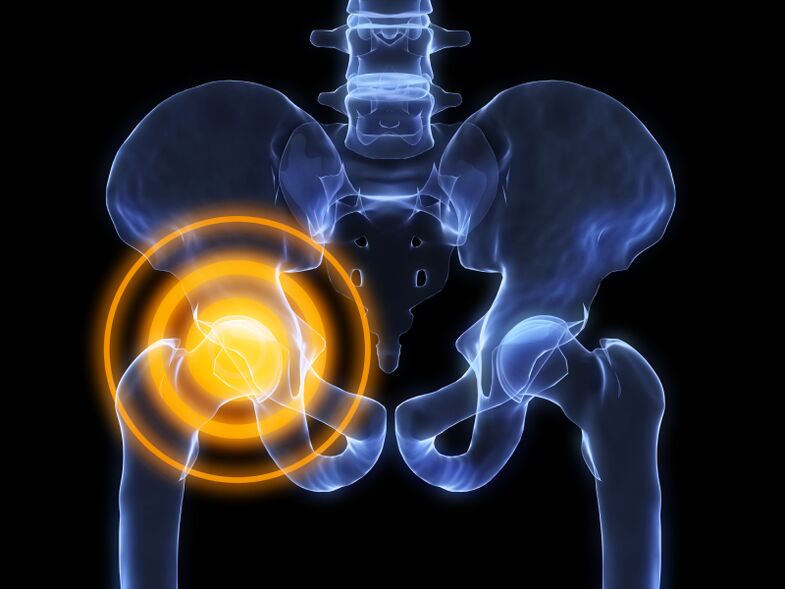Osteoartrite da articulación da cadeira
